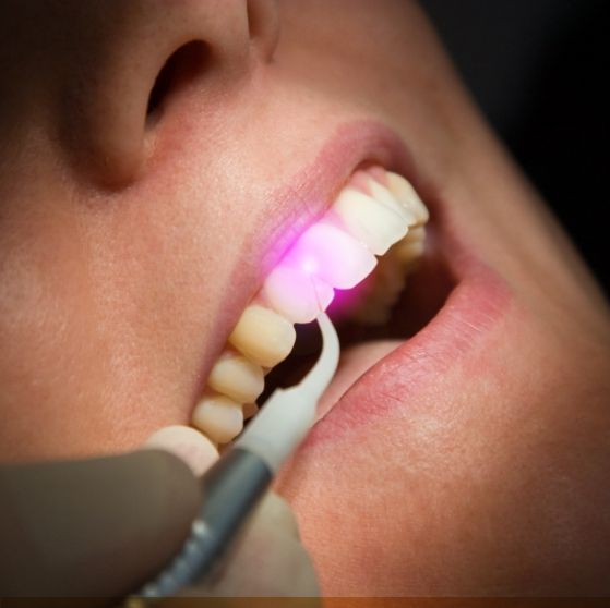 Close up of dental patient receiving laser treatment on their gums