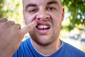 Man lifting his lip to reveal chipped tooth