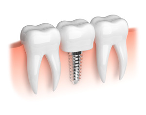 Illustration of dental implant between two natural teeth